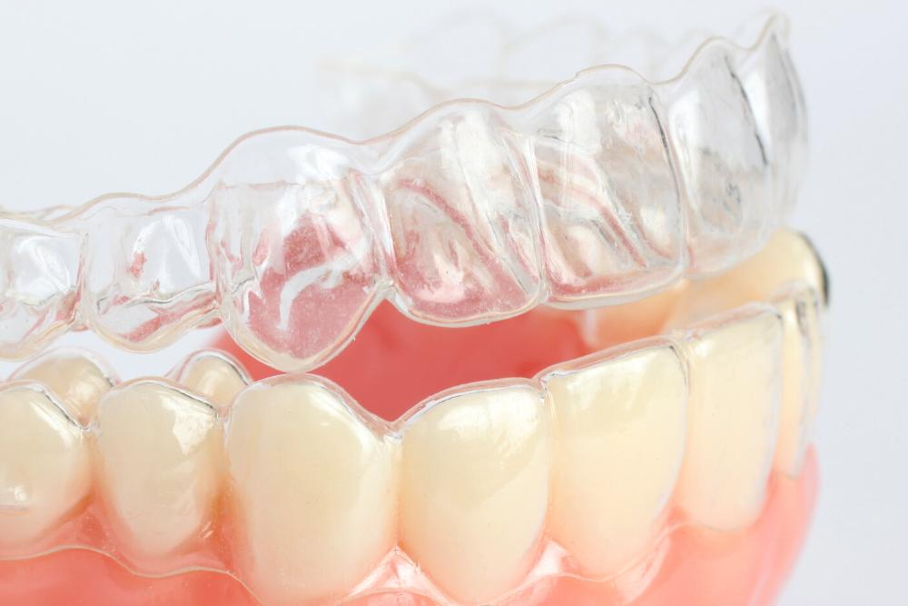 invisalign aligners 