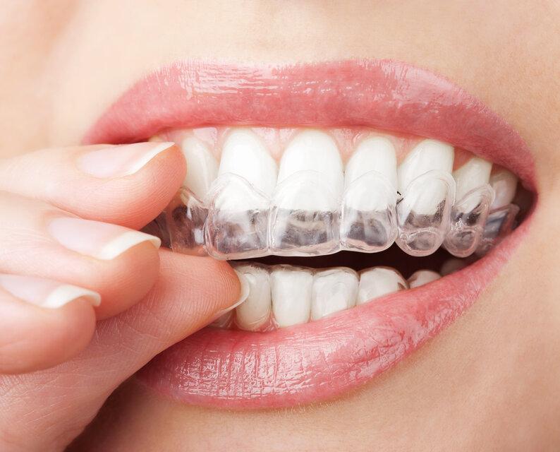 close up of person using invisalign from Urbandale dental office