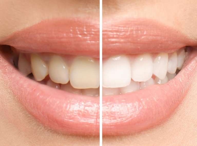 teeth whitening result before and after